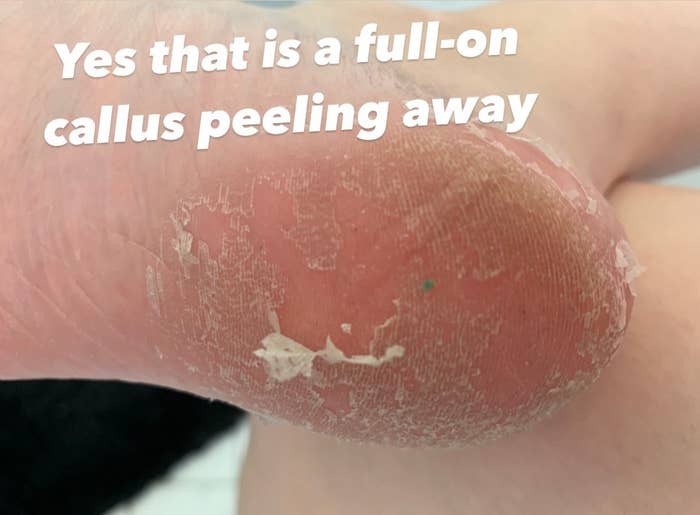 Dead callus skin peeling away from author&#x27;s heel
