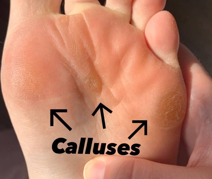 Author&#x27;s foot with hardened calluses on three areas of the ball of the foot