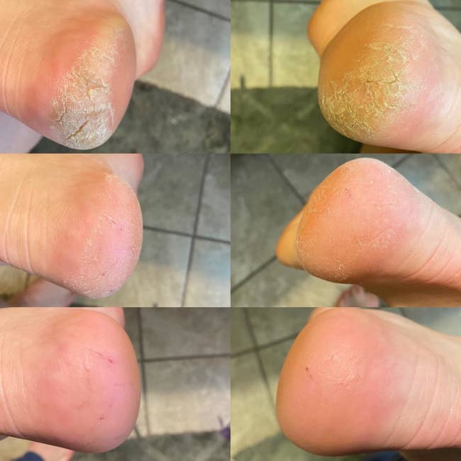a reviewer photo of both feet before, immediately after, and the morning after using the callus remover