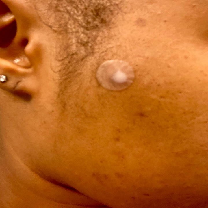 reviewer wearing a pimple patch on their face with lots of pus being pulled out of the pimple