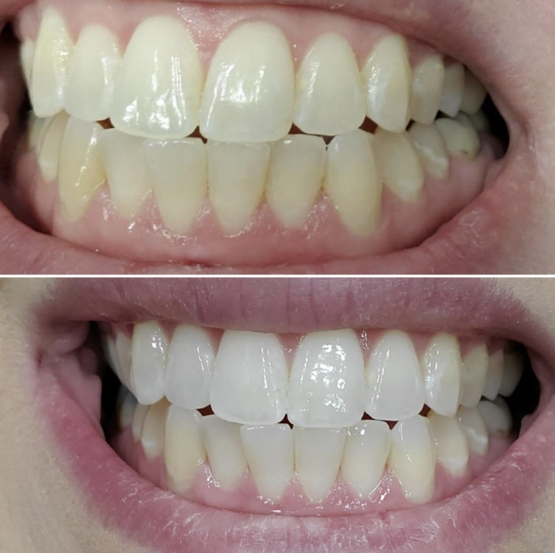 A before and after of teeth