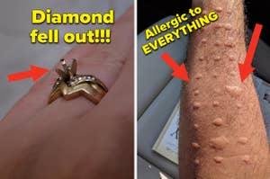 A ring where the diamond fell out, and an having allergic reactions to all allergies
