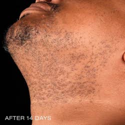 after photo of the same model's face, noticeably clearer, after using the post-shave anti-bump cream