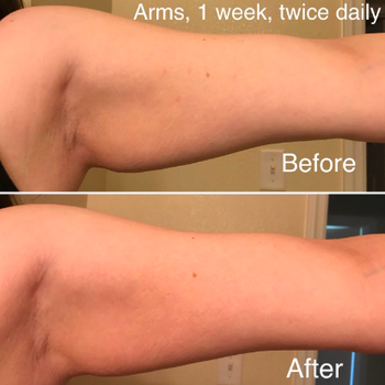 Reviewer before and after using the product on arms. Showing their desired results improving after one week of brushing twice daily.