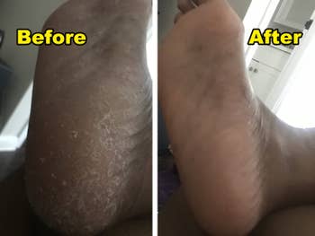 a split before and after of a reviewer's foot looking dry and cracked and the same foot looking moisturized