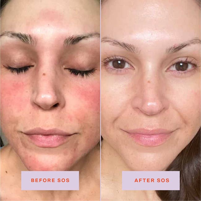 A before/after showing reduced redness and irritation after using the spray