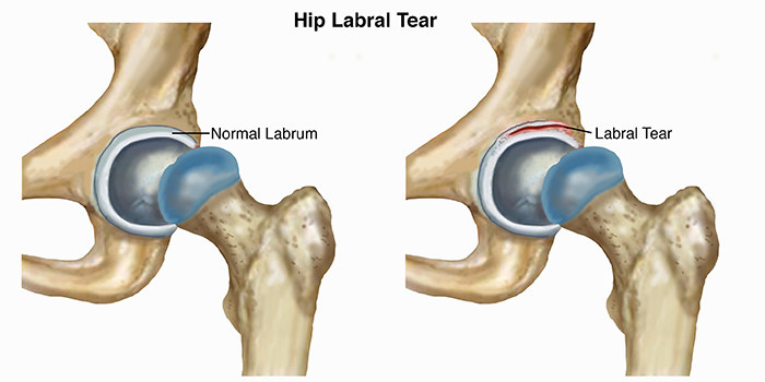 A diagram. showing a normal labrum and a torn labrum