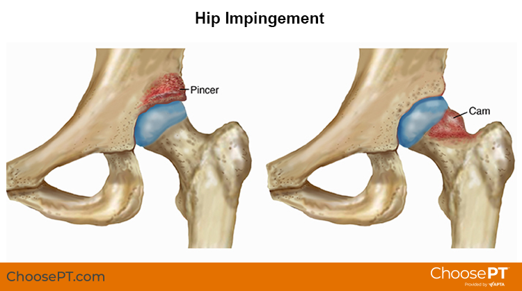 A diargram showing the difference between cam and pincer hip deformities