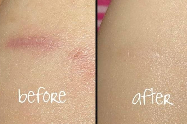 Before and after showing the oil reduced the redness of a reviewer's scar and made it almost invisible