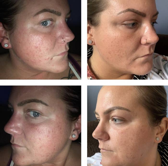 a before and after of a person with significantly less breakouts after using this set