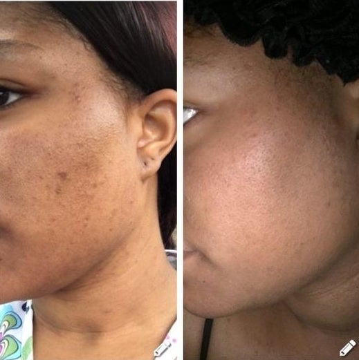Reviewer&#x27;s before-and-after of scarred cheeks and then clear complexion 
