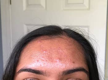 Reviewer showing forehead before using oil blotting sheets