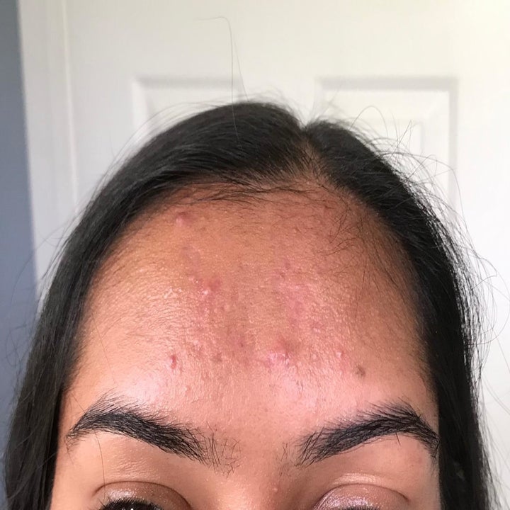 Reviewer showing forehead after using oil blotting sheets
