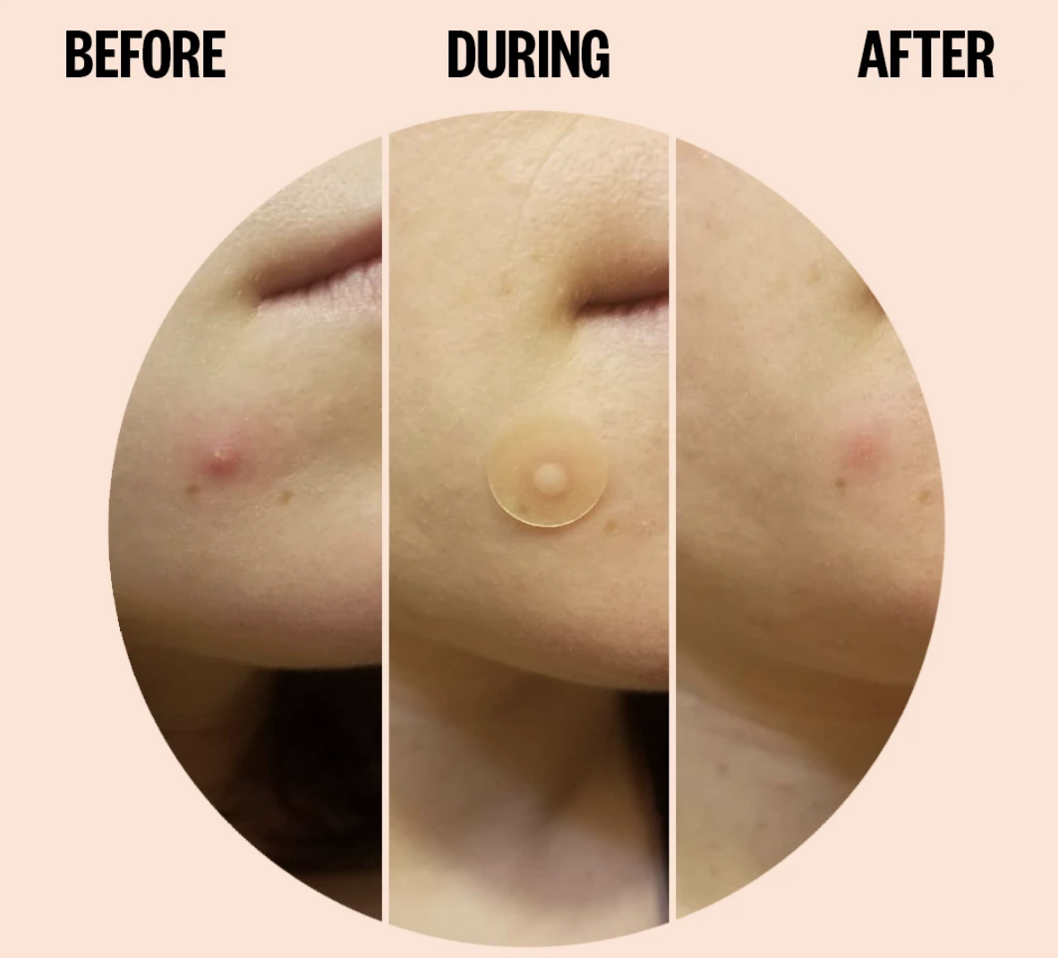before and after photo of model with visible acne on left and visibly less on the right 