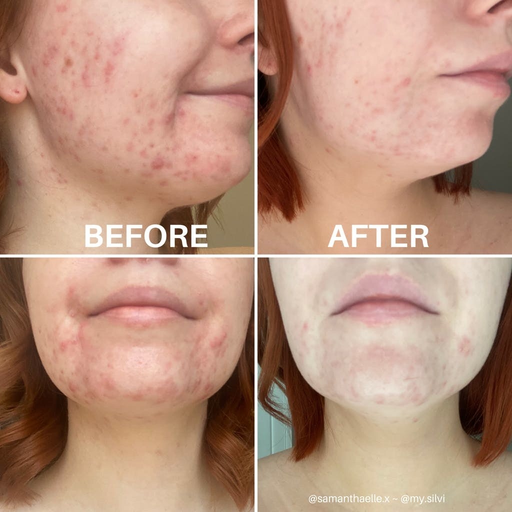 A before and after showing a dramatic reduction in acne and redness after using the Silvi pillowcase