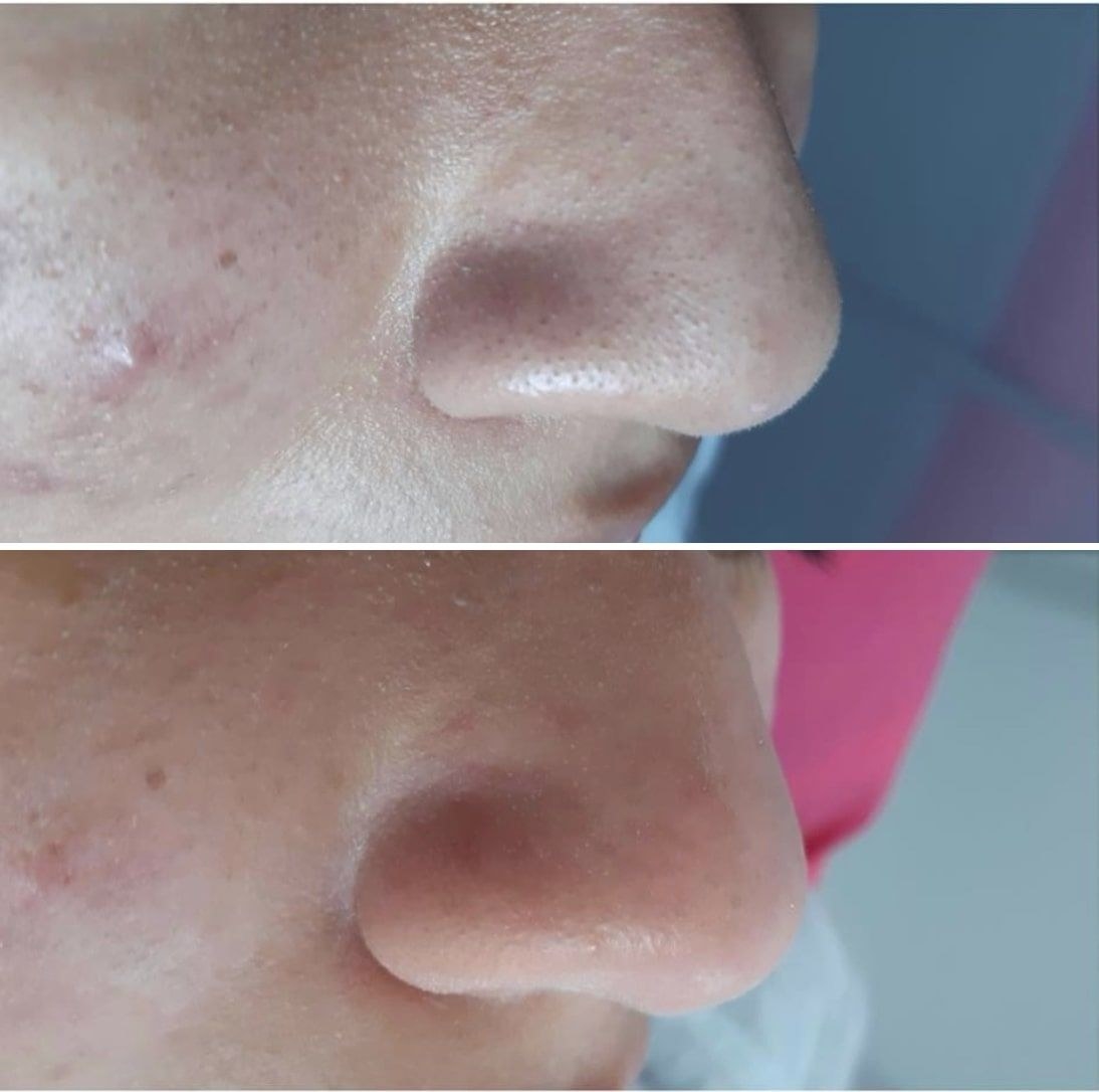 A before and after close-up of a nose with much clearer pores
