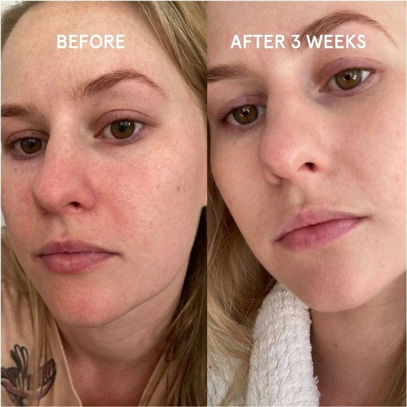 A before and after showing a woman&#x27;s face is far less red and inflamed after 3 weeks of using the pillowcase