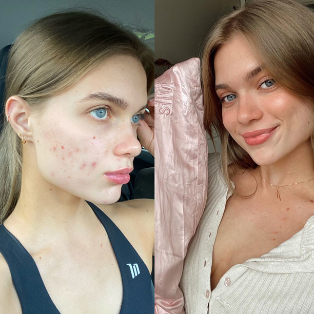 A before and after showing a woman with completely clear skin after using the Silvi pillowcase