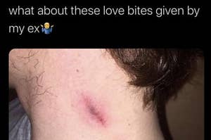 A guys hickey, captioned "what about these love bites given by my ex"