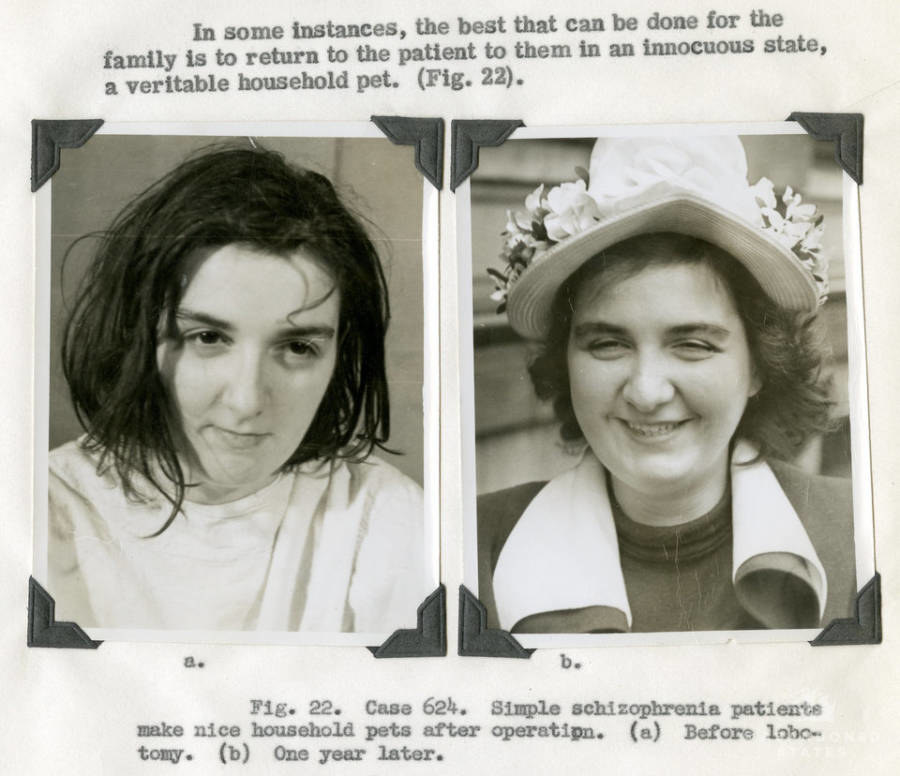 ad for lobotomies with a before and after schizophrenia patient looking happier after, calling them a &quot;veritable household pet&quot;