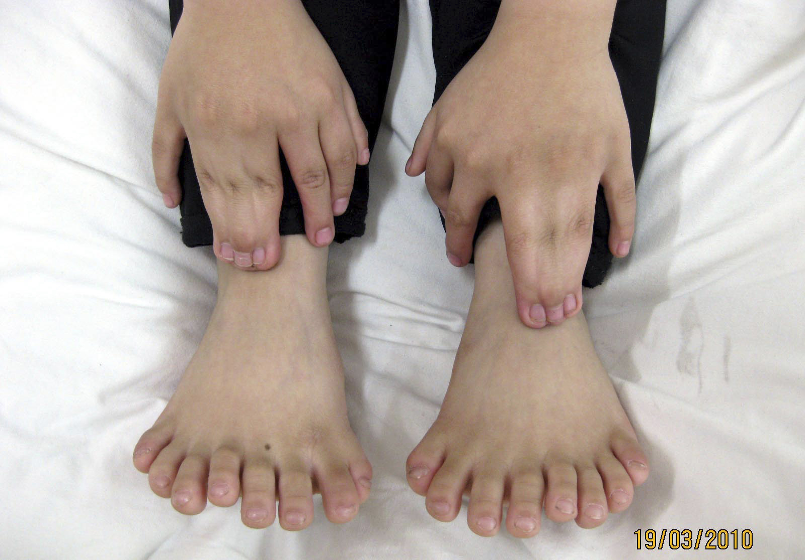 6-year-old Li Jinpeng has 15 fingers and 16 toes