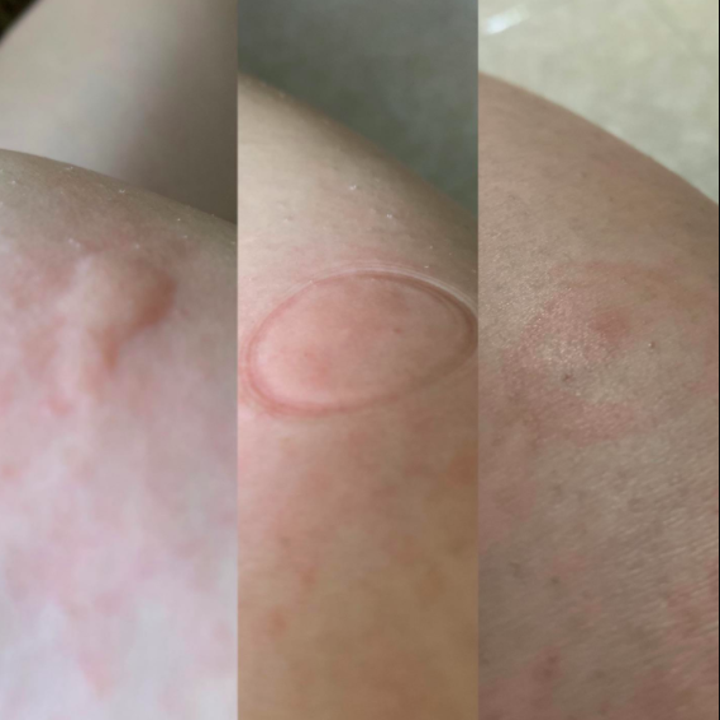 a reviewer's before and after shot of a swollen bug bite and flat bug bite after using the device