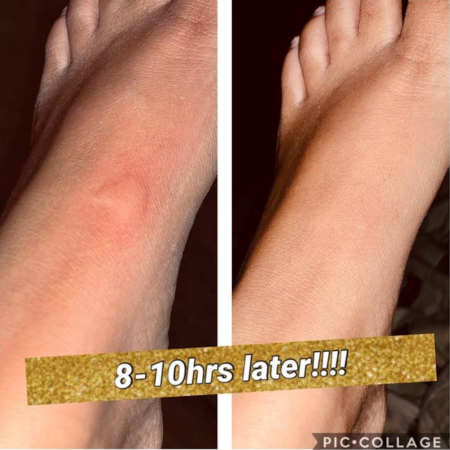 reviewer with a large bite on their foot and then the same area flat 8-10 hours later