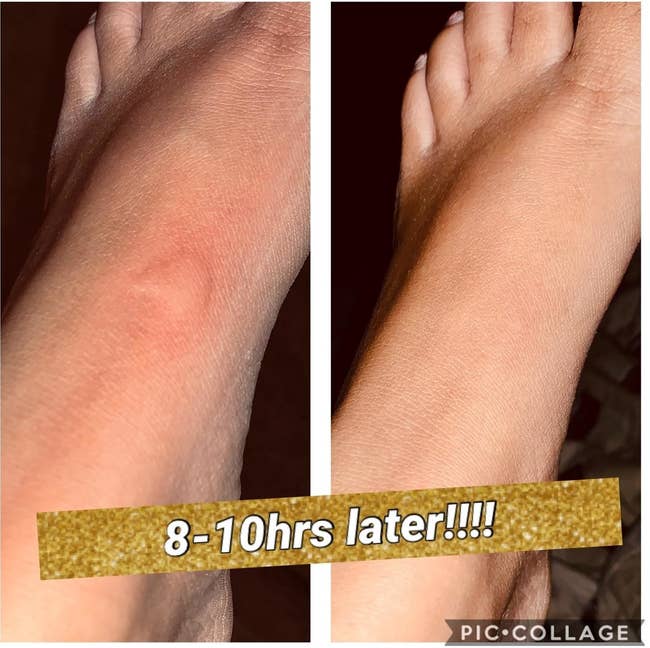 reviewer with a large bite on their foot and then the same area flat 8-10 hours later