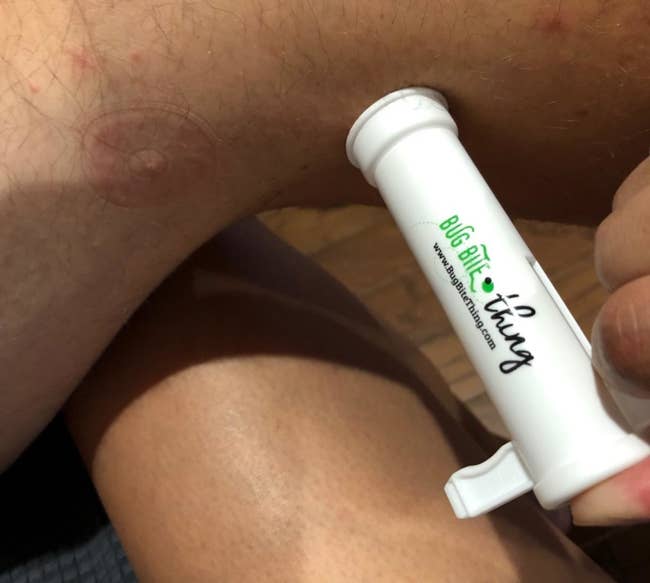 a reviewer photo of someone using The Bug Bite thing on their leg 