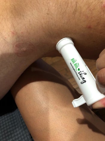 a reviewer photo of someone using The Bug Bite thing on their leg 
