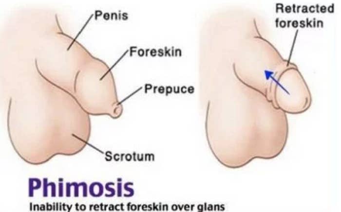 A diagram of phimosis