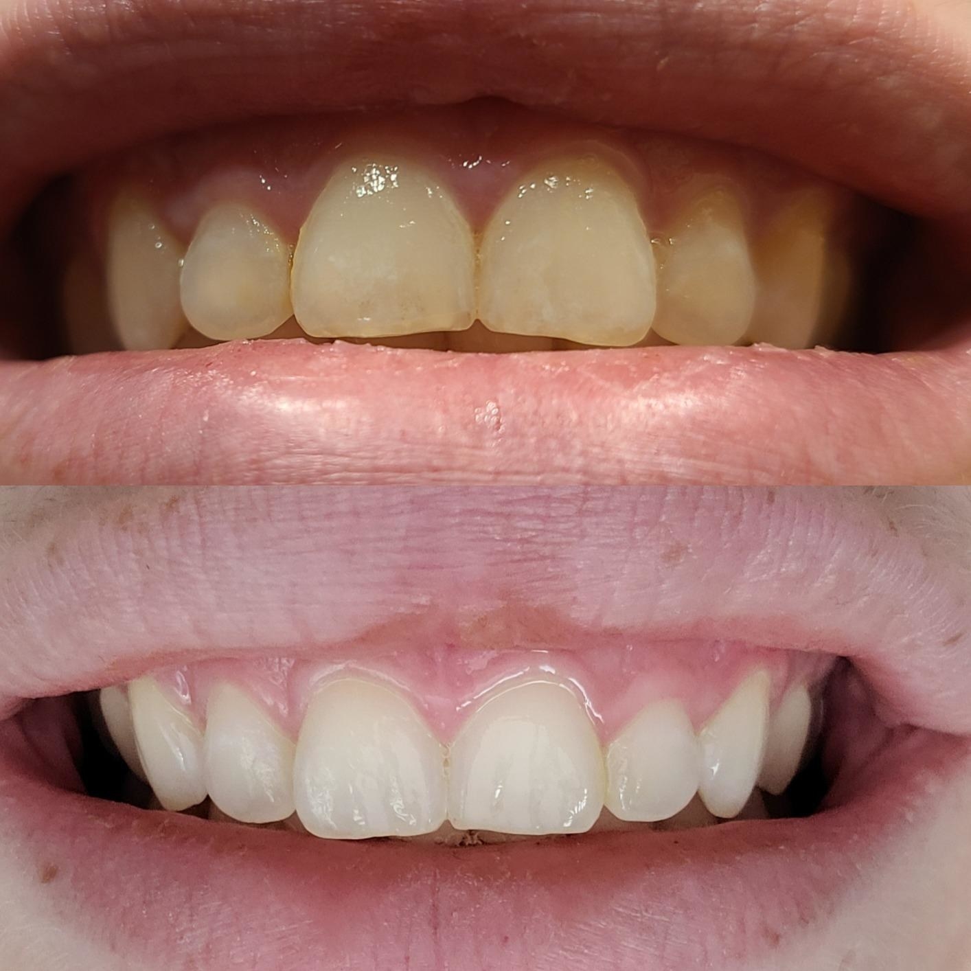A customer&#x27;s before and after pictures side by side; in the before their teeth are yellowed and in the after they are noticeably whiter