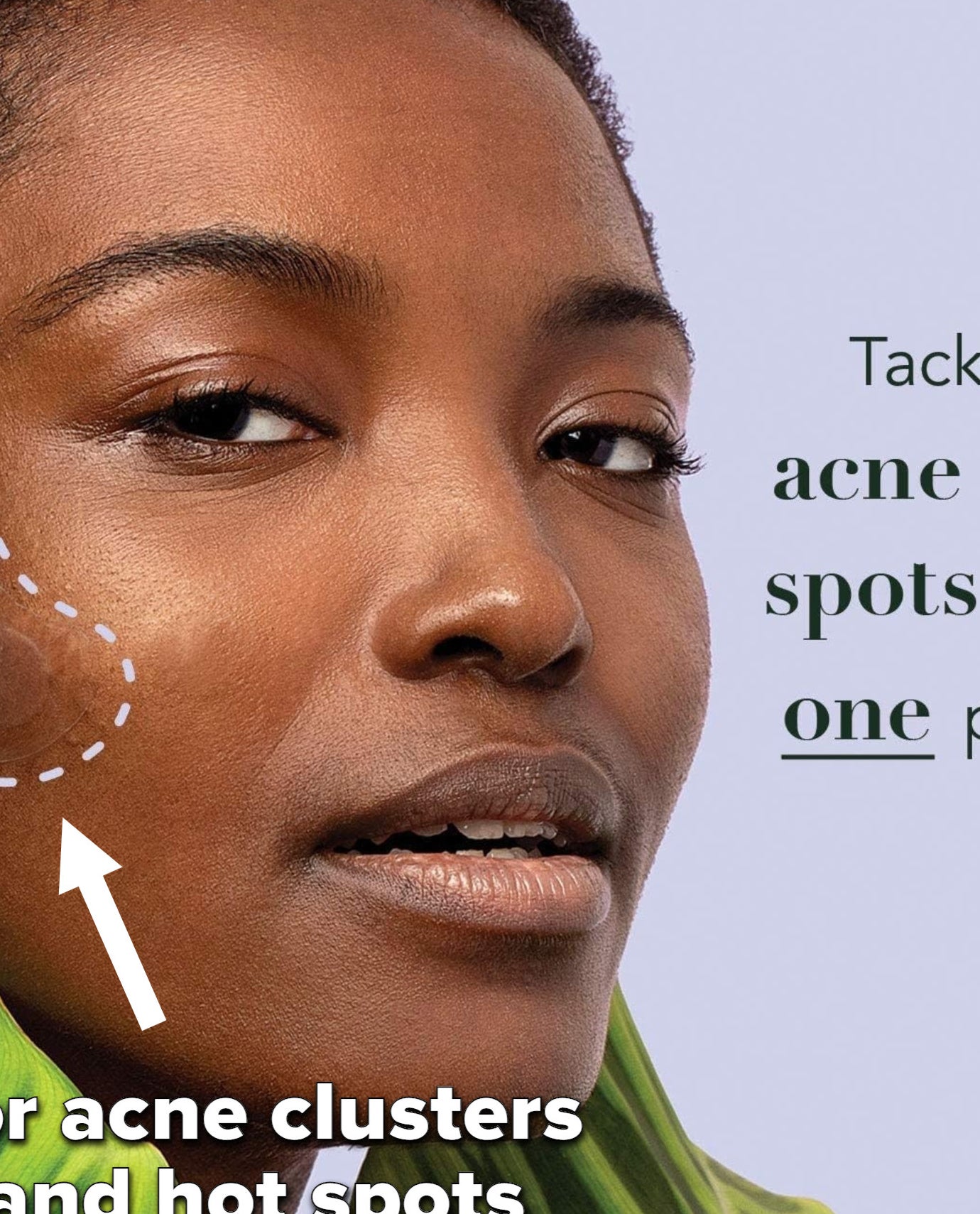 a person wearing the acne patch on their cheek