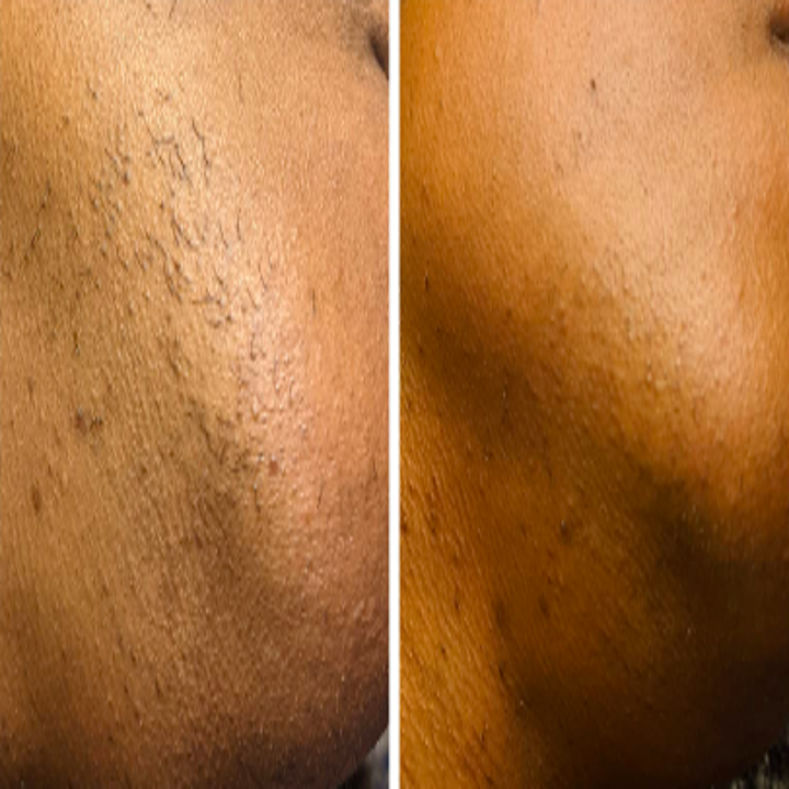 Reviewer's chin before and after using the wax to remove hair 