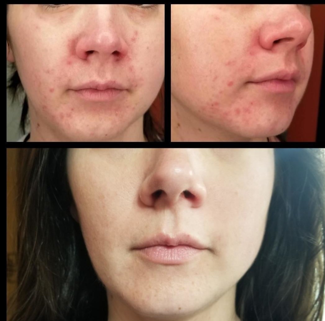 a split before and after image of a reviewer with acne around their chin and the acne cleared up
