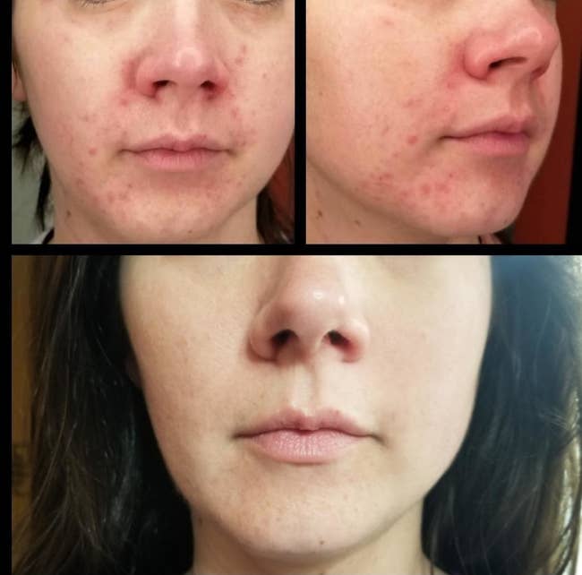 a split before and after image of a reviewer with acne around their chin and the acne cleared up