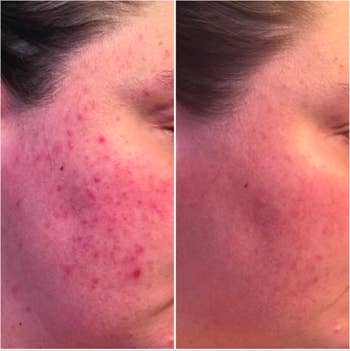A customer review photo of before and after using the Humane Acne Body & Face Wash