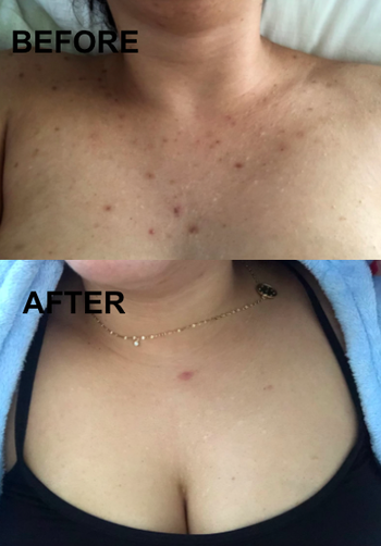 A before and after customer review photo showing the results from using the Ambi Skincare Fade Cream on their chest acne