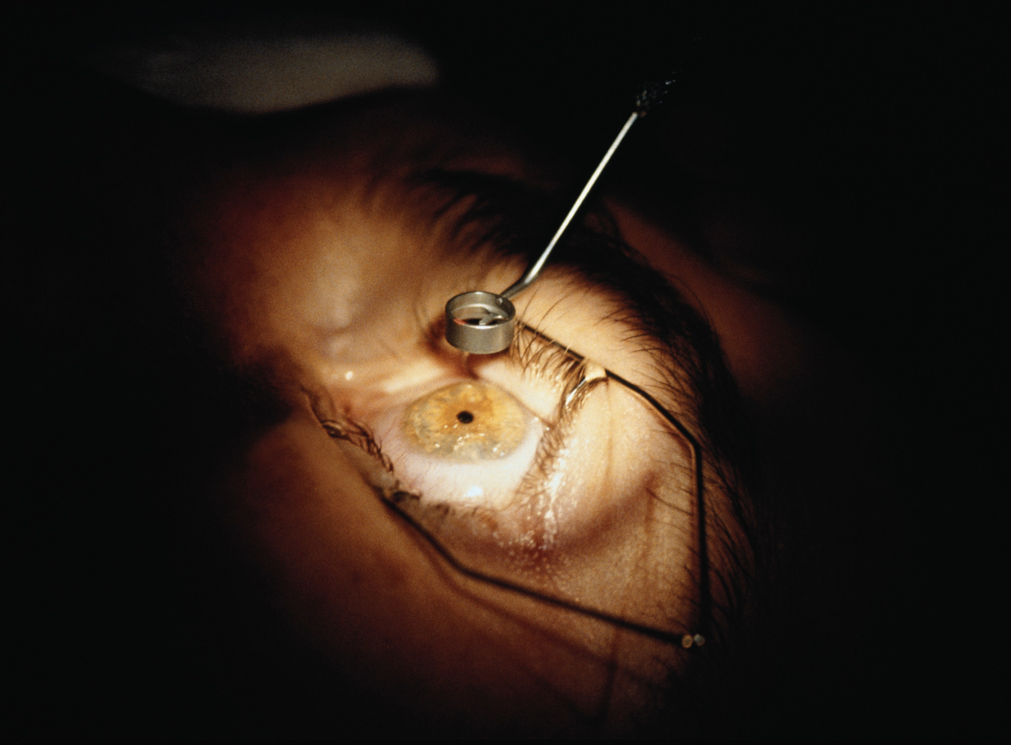 A close-up of an eye during surgery