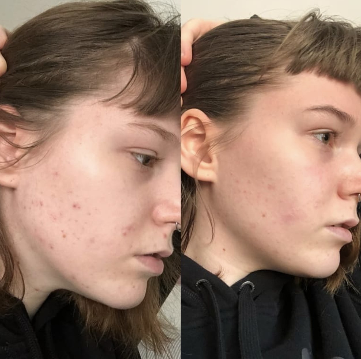 a reviewer before and after one week of using solution by glossier