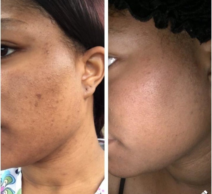 on the left, a reviewer with acne scars on their cheek and, on the right, the same reviewer with the look of the scars dramatically reduced