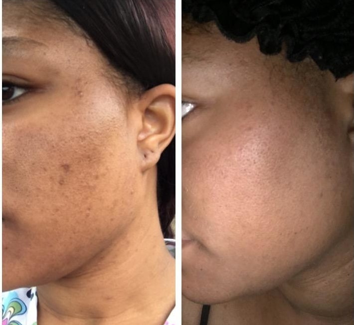 on the left, a reviewer with acne scars on their cheek and, on the right, the same reviewer with the look of the scars dramatically reduced