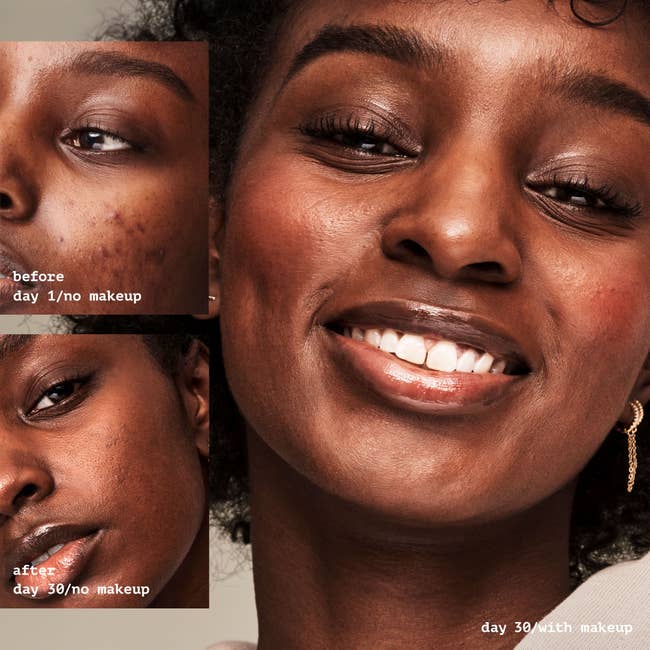 model showing before and after 30 days with a significant improvement in their acne