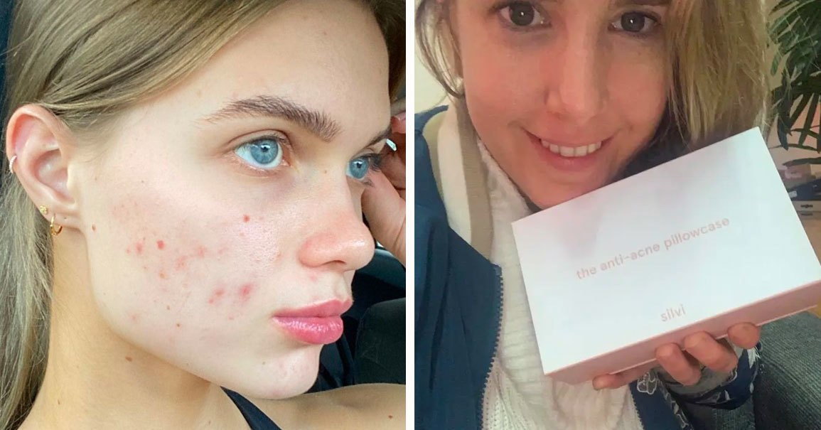 could my pillow be causing acne