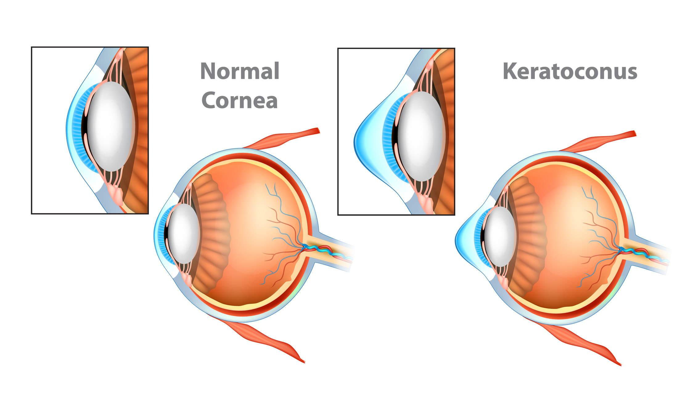 A keratoconus diagram