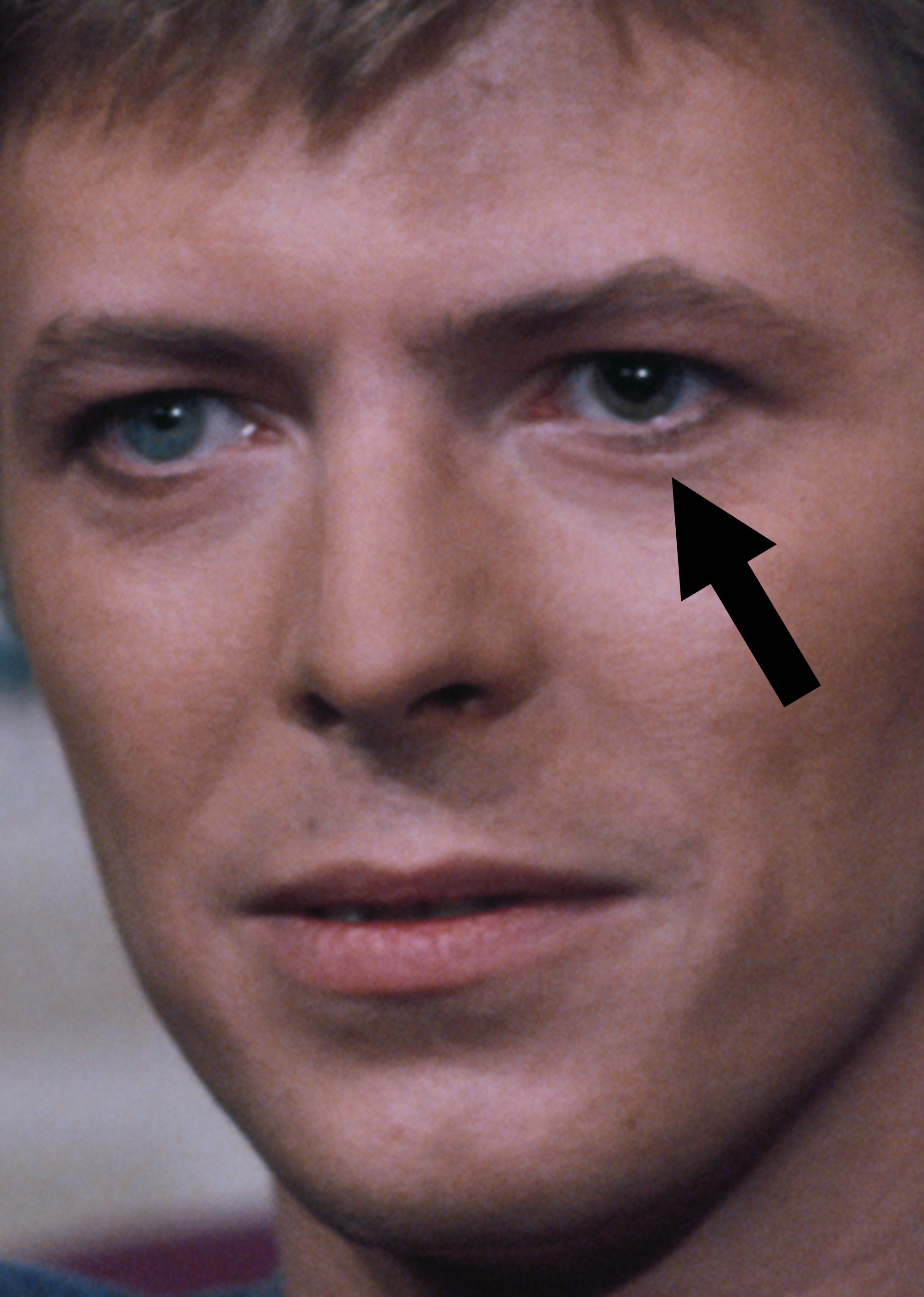 Close-up of David&#x27;s face with an arrow pointing at his left eye