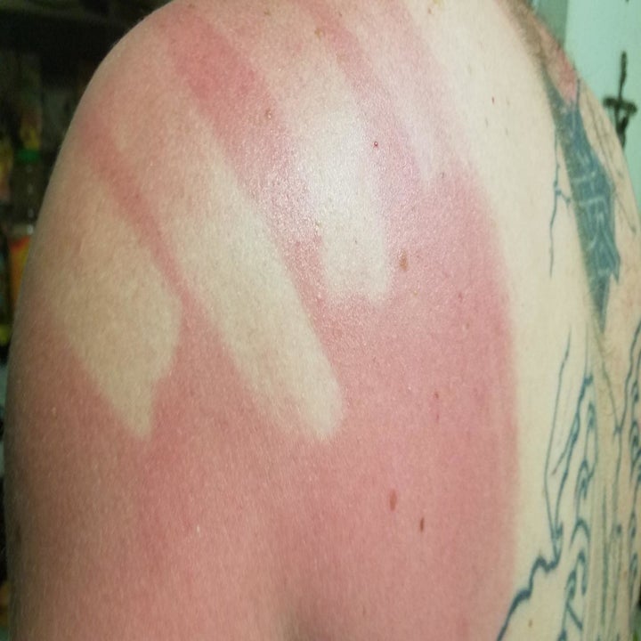 Reviewer's photo showing sunburnt skin in areas where they didn't apply the sunscreen