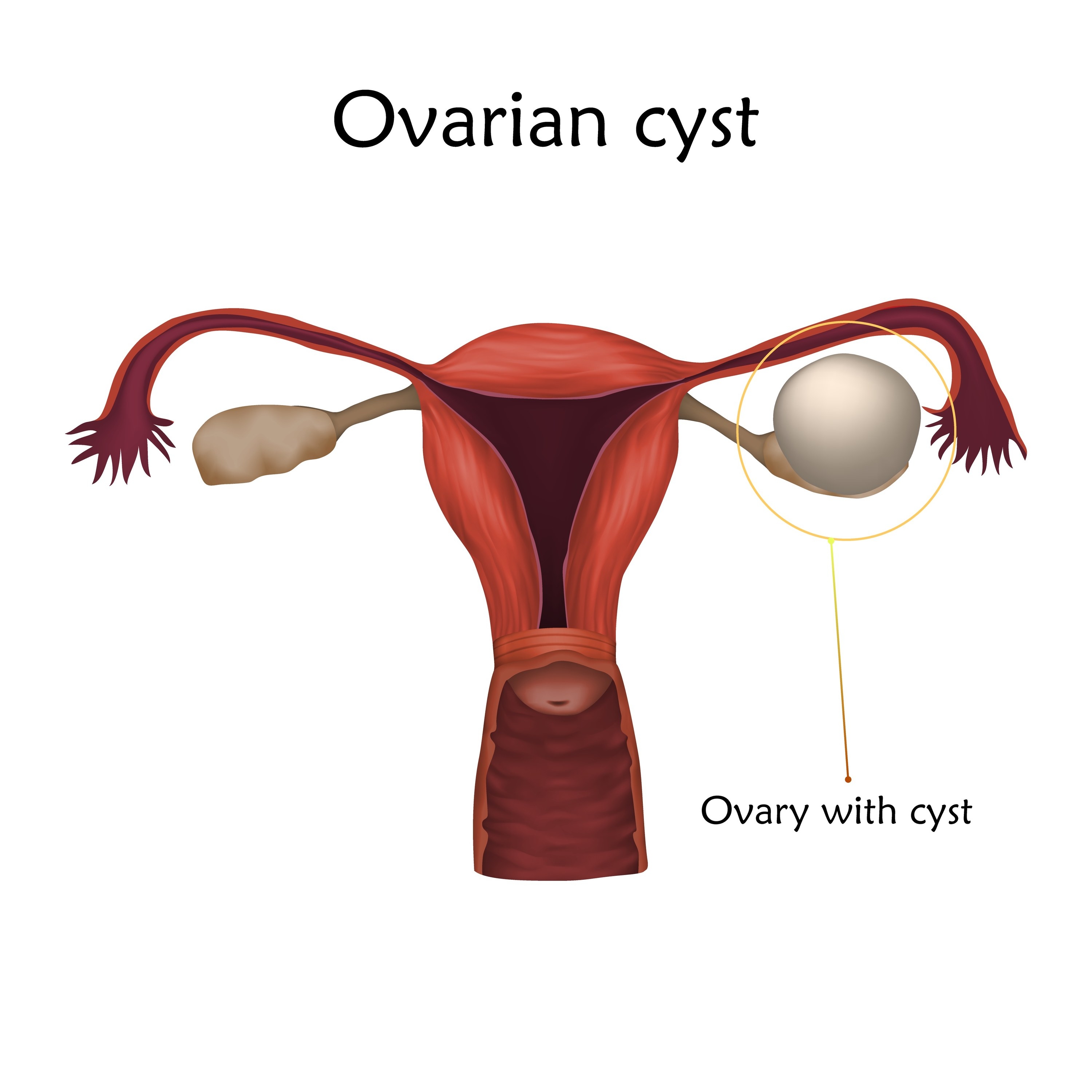 CAN OVARIAN CYSTS CONTRIBUTE TO INFERTILITY?: Rocky Mountain