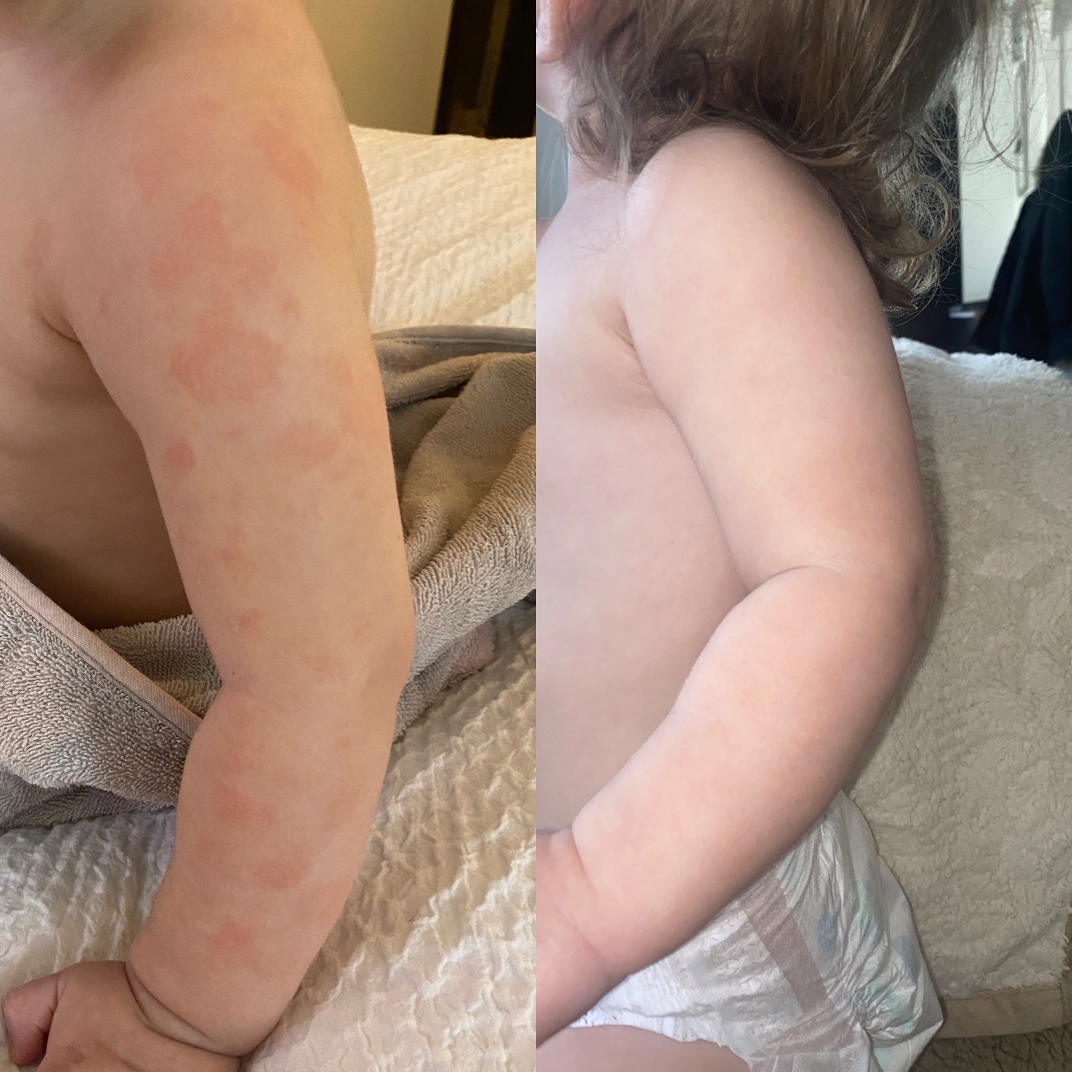 Reviewer&#x27;s before photo showing their child&#x27;s arm covered with eczema rashes and after photo showing the arm with the eczema rashes gone