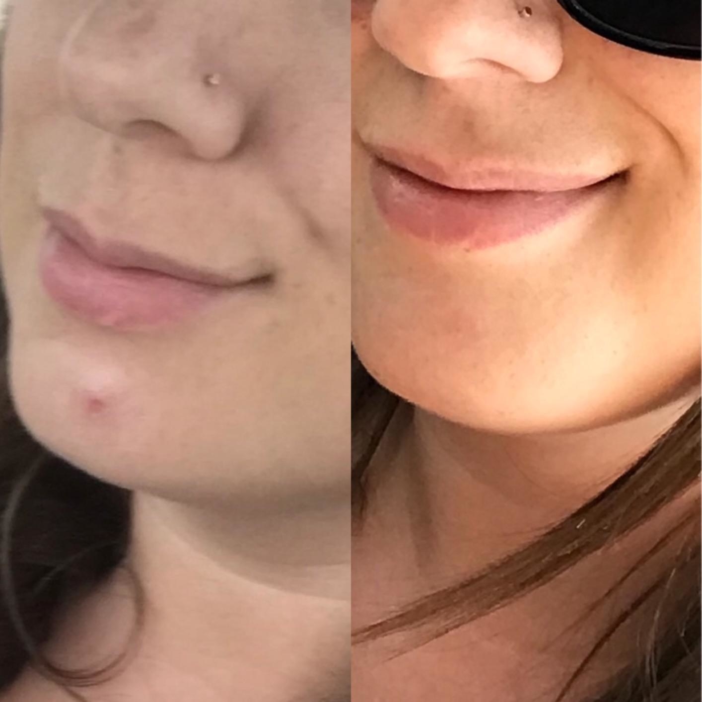 Reviewer&#x27;s before photo showing a pimple on the chind, and an after photo showing the pimple gone